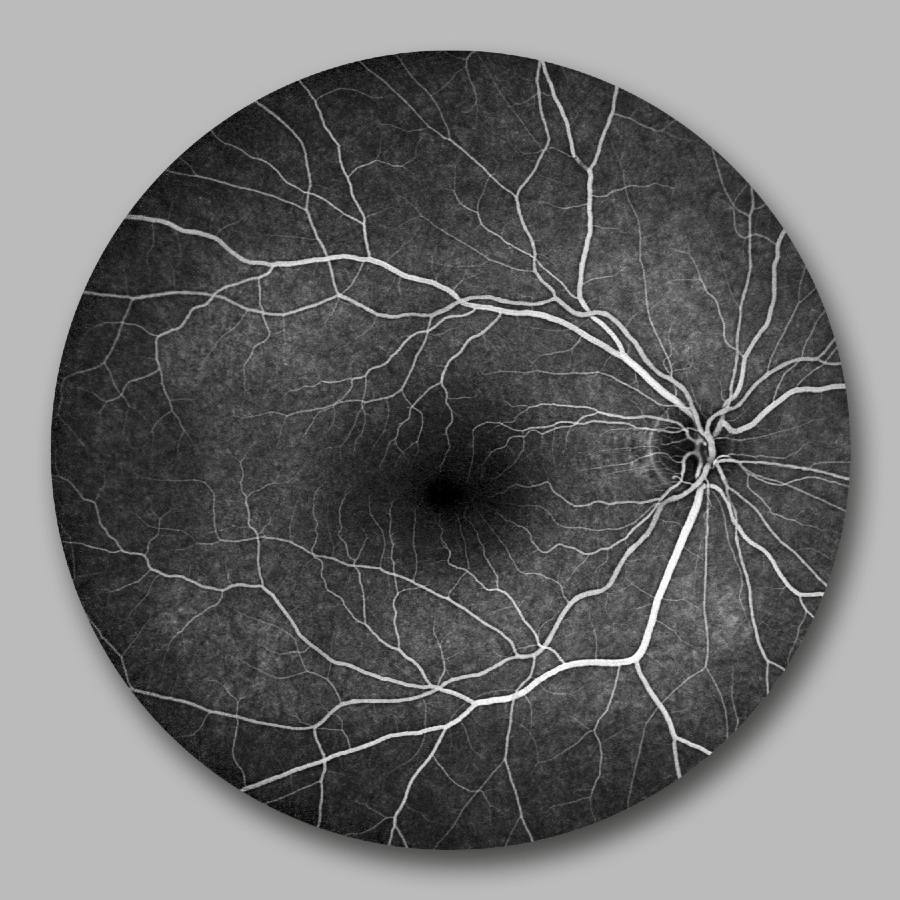 schwarz-weiß Aufnahme der Blutgefäße im Auge