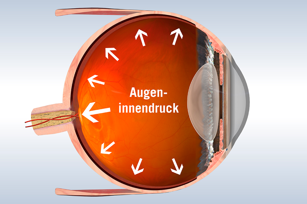 Grüner Star (Glaukom): Grafik des Auges mit Einzeichnung des erhöhten Augeninnendrucks im Glaskörper