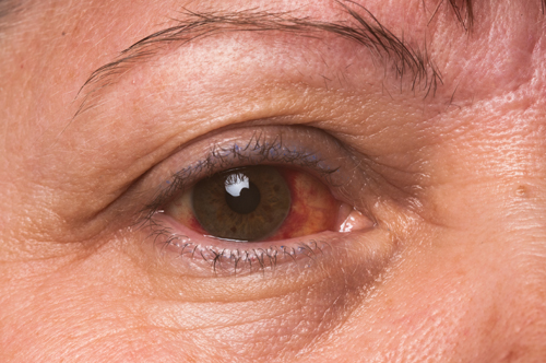 Auge mit Rötung infolge Bindehautentzündung
