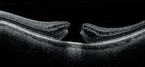 schwarz weiß Bild Makulaloch im Schnittbild b-Scan