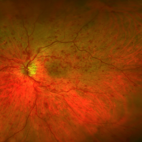 Retinale Gefäßverschlüsse: Bild von Blutungen bei Gefäßverschluss der Netzhaut
