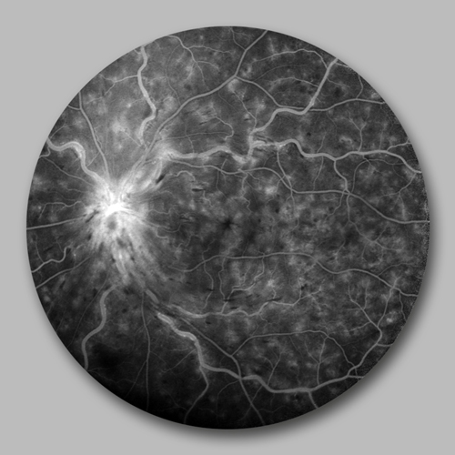 Aufnahme einer Fluoreszenzangiographie bei retinalem Gefäßverschluss